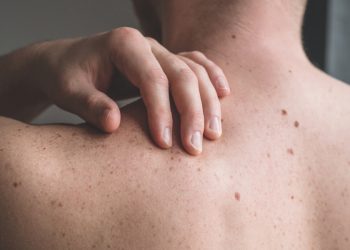 New Data Predicts Melanoma Cases Rising in 2026