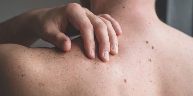 New Data Predicts Melanoma Cases Rising in 2026
