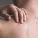 New Data Predicts Melanoma Cases Rising in 2026