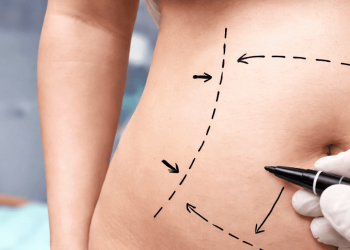 How Does Liposculpture Work? A Step-by-Step Look at the Procedure