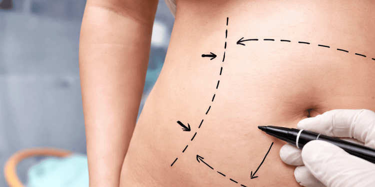 How Does Liposculpture Work? A Step-by-Step Look at the Procedure