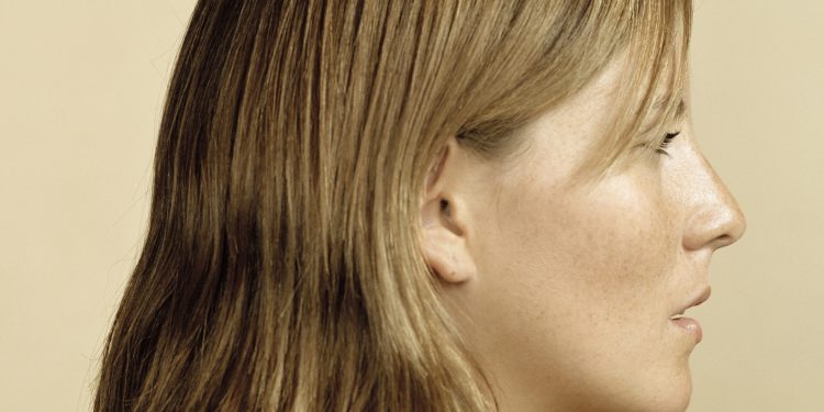 RHA Dynamic Volume Filler Gets FDA Approval for Cheeks