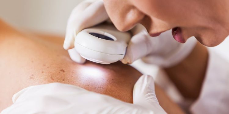 What Skin Cancer Can Really Look Like