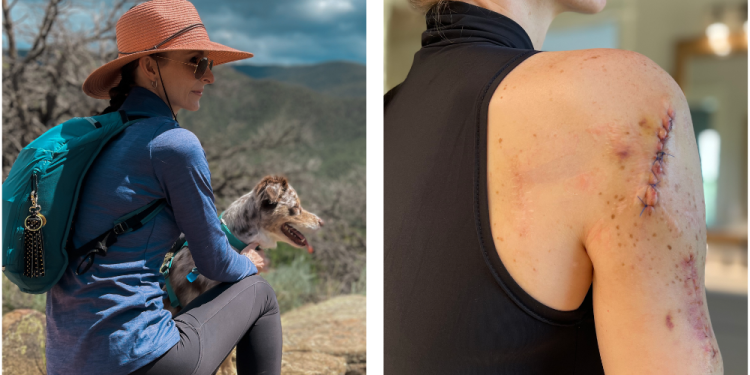 I Was the Pale Girl in High School—Now I’m a Four-Time Melanoma Survivor