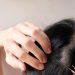 Dandruff or Skin Cancer? How to Tell the Difference on Your Scalp