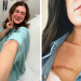 I Was 26 When Melanoma Changed Everything: A Survivor’s Story