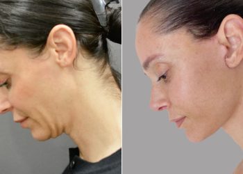 Inside the Rise of the 40-Something Facelift