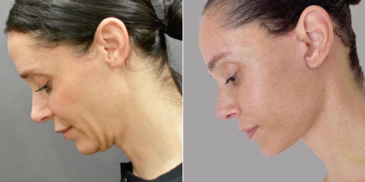 Inside the Rise of the 40-Something Facelift