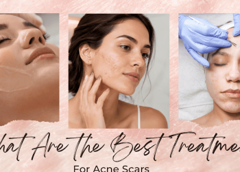 What Are the Best Treatments for Acne Scars?
