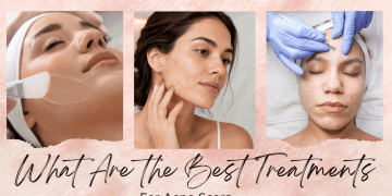 What Are the Best Treatments for Acne Scars?