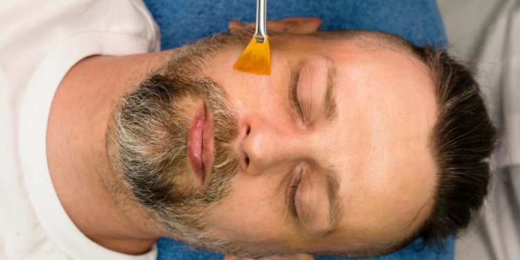 A TikToker’s At-Home 30 Percent TCA Peel Has 25 Million Views—and Doctors Are Worried