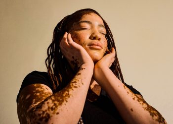Vitiligo Affects More Than Skin, a New Survey Finds