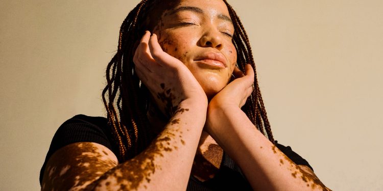 Vitiligo Affects More Than Skin, a New Survey Finds
