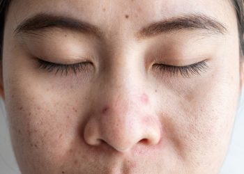 Struggling to Sleep? Dermatologists Say Your Acne Could Be the Culprit