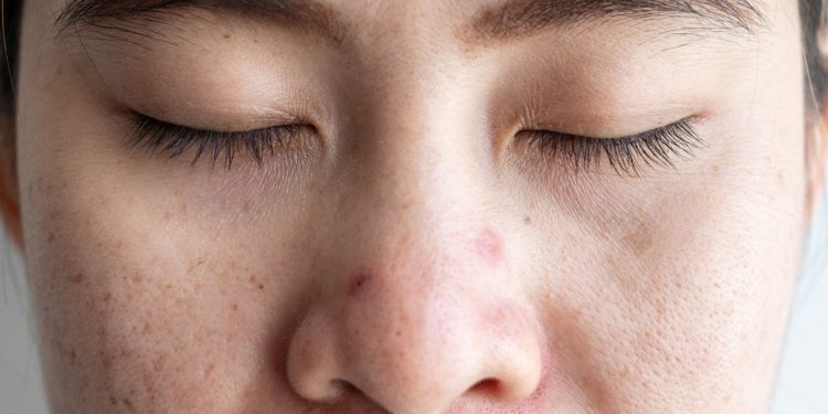 Struggling to Sleep? Dermatologists Say Your Acne Could Be the Culprit