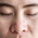 Struggling to Sleep? Dermatologists Say Your Acne Could Be the Culprit