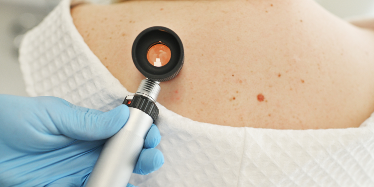 The Uncommon Signs of Skin Cancer Doctors Want You to Know