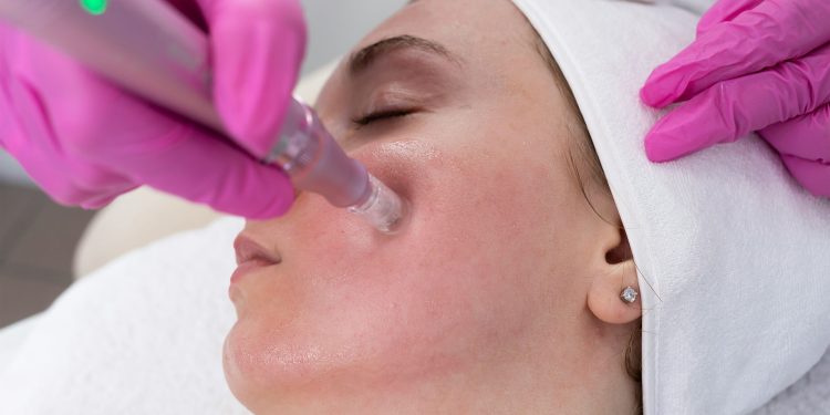 Is It Safe to Get Microneedling in the Summer? We Asked the Experts