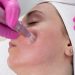 Is It Safe to Get Microneedling in the Summer? We Asked the Experts