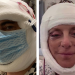 7 Celebrities Who Got Candid About Their Post-Procedure Recovery and Results