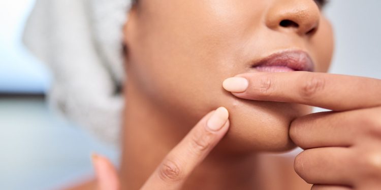 Why Your Chin Keeps Breaking Out, and How to Finally Stop It