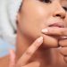 Why Your Chin Keeps Breaking Out, and How to Finally Stop It